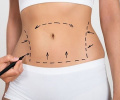 Abdominoplastia