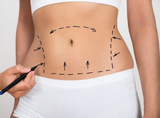 Abdominoplastia