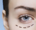 Blefaroplastia